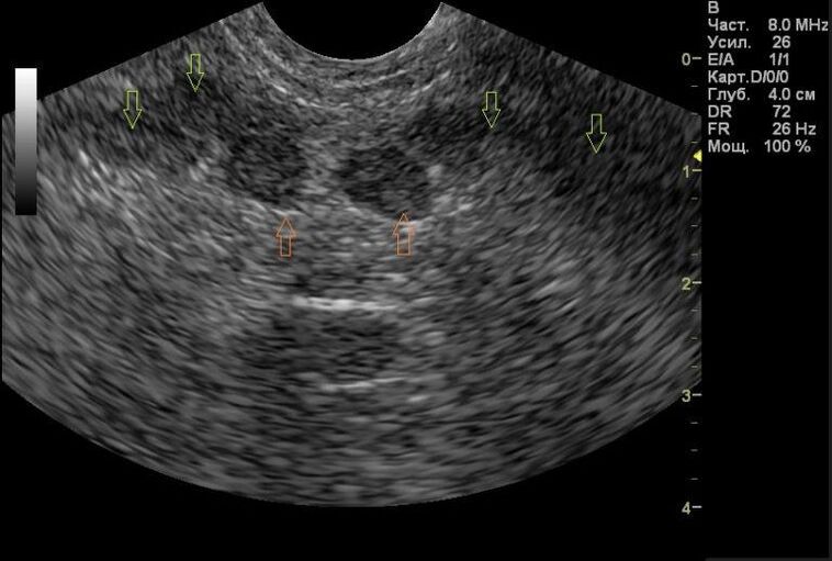 prostatitis na mojich vysledkoch ultrazvuku